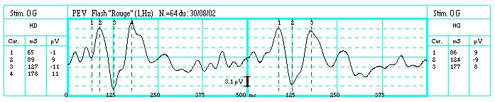 Characteristic waves of flash VEP